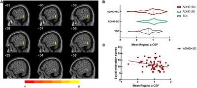 Cerebral blood flow characteristics of drug-naïve attention-deficit/hyperactivity disorder with social impairment: Evidence for region–symptom specificity